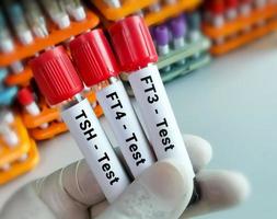 Blood samples for hormonal examination of thyroid gland in laboratory. FT3, FT4, TSH. Diagnosis of hyperthyroidism or hypothyroidism of a patient. Lab background. photo