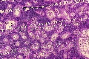 fotomicrografía o imagen microscópica del cáncer de estómago. adenocarcinoma de estómago foto