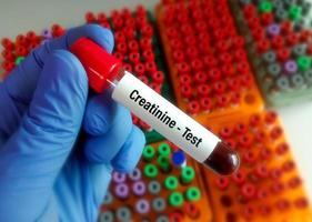 Blood sample for creatinine test. Diagnosis of kidney or renal disease photo