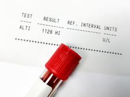 Blood sample isolated for ALT test for the diagnosis of Liver function test  with abnormal patient report. photo