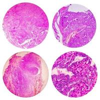 Photo collage of microscopic image showing Papillary thyroid carcinoma.