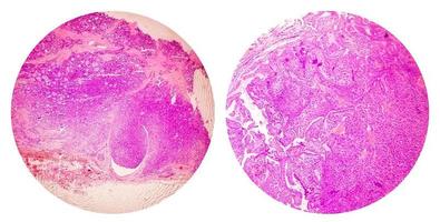 collage de fotos de imagen microscópica que muestra carcinoma papilar de tiroides.