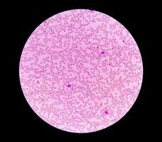 fotomicrografía o imagen microscópica que muestra el rasgo de hemoglobina d con anemia por deficiencia de hierro. foto