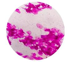 Gram staining, also known as Gram's method, is a method of differentiating bacterial species into two large groups called Gram positive and Gram negative. photo