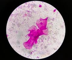 Gram staining, also known as Gram's method, is a method of differentiating bacterial species into two large groups called Gram positive and Gram negative. photo