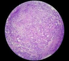 fotomicrografía o imagen microscópica del cáncer de estómago. adenocarcinoma de estómago foto