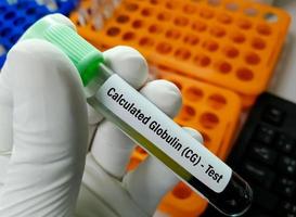 Calculated globulin or CG test is derived from the difference between total protein and albumin results and forms part of the liver function test or LFT profile. photo