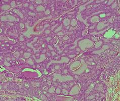 Thyroid cancer, Microscopic image of Metastatic papillary carcinoma of thyroid, central lymph node. photo
