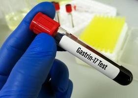 Blood sample for Gastrin 17 test  to detect excess production of gastrin and gastric acid. It is used to help diagnose gastrinoma, Zollinger-Ellison syndrome and hyperplasia of G cells. photo