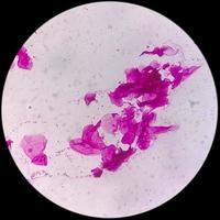 Gram staining, also known as Gram's method, is a method of differentiating bacterial species into two large groups called Gram positive and Gram negative photo