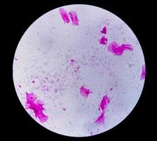 Gram staining, also known as Gram's method, is a method of differentiating bacterial species into two large groups called Gram positive and Gram negative. photo