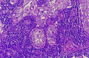 Photomicrograph or microscopic image of Stomach cancer. Adenocarcinoma of stomach photo