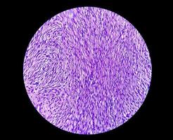 Photomicrograph of a schwannoma, a benign soft tissue tumor of peripheral nerve sheath. photo