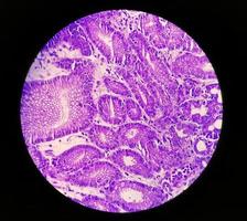 fotomicrografía o imagen microscópica del cáncer de estómago. adenocarcinoma de estómago foto