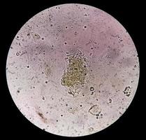 Microscopic image showing Calcium oxalate crystal and others urinary crystals from urine sediment. photo