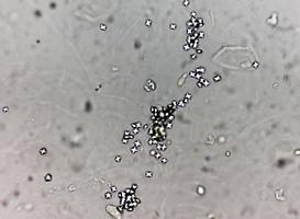 Microscopic image showing Calcium oxalate crystal from urine sediment. photo