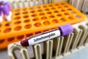 Sulfmethemoglobin blood test. The complex formed by the reaction of a sulfide and hemoglobin in the presence of oxygen. photo