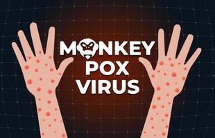 Monkeypox virus infection on hand banner concept. Monkey pox disease outbreak blisters and rash on arm skin. MPV MPVX danger and public health epidemic risk. Smallpox illness symptom. Vector