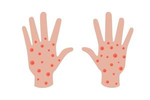 Monkeypox virus infection on hand banner concept. Monkey pox disease outbreak blisters and rash on hand skin. MPV MPVX danger and public health epidemic risk. Vector eps illness symptom illustration