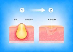 acné inflamado en la piel. inflamación asociada con las espinillas. la estructura de la cicatriz del acné de la piel. concepto de cuidado de la piel de belleza médica. Ilustración vectorial 3d. vector