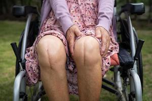 Asian senior or elderly old lady woman patient show her scars surgical total knee joint replacement Suture wound surgery arthroplasty on bed in nursing hospital ward, healthy strong medical concept. photo