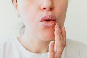 Close up of girl lips affected by herpes. Treatment of herpes infection and virus. Part of young woman face with finger touching pain on lips with herpes affected. Beauty dermatology concept. photo