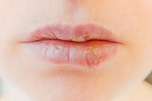 Close up of girl lips affected by herpes. Treatment of herpes infection and virus. Part of young woman face, lips with herpes affected. Beauty dermatology concept. photo