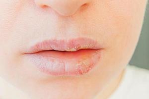 Close up of girl lips affected by herpes. Treatment of herpes infection and virus. Part of young woman face, lips with herpes affected. Beauty dermatology concept. photo