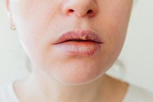 Close up of girl lips affected by herpes. Treatment of herpes infection and virus. Part of young woman face, lips with herpes affected. Beauty dermatology concept. photo