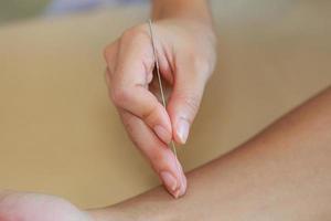 primer plano de la mano que realiza la terapia de acupuntura en la mano del paciente. foto