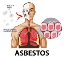 diagrama que muestra la asbestosis en los pulmones vector