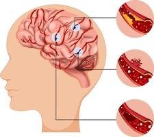 humano con tipos comunes de infografía de accidente cerebrovascular vector