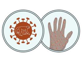 Monkeypox banner, symbolic image of virus and human hand with skin symptoms vector