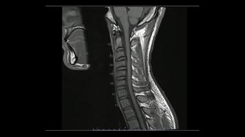 imágenes de resonancia magnética de la columna cervical imágenes sagitales ponderadas en t1, resonancia magnética de la columna cervical, que muestran enfermedad de disco múltiple, más evidente en el disco c5-6. foto