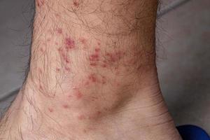 allergic reactions to tick bites photo