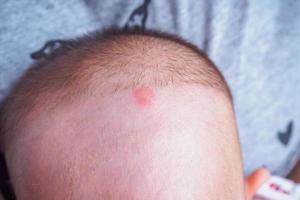 Asian baby girl with mosquito sting red spot on head photo