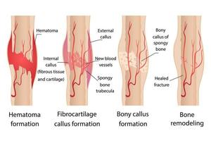 Stages of healing of bone fractures. vector