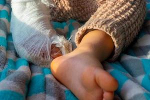 Child with bandage on leg heel fracture. Broken right foot, splint of toddler. Little boy sleeping on a blue blanket. photo