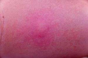 la piel del brazo tiene alergias a la picadura de mosquitos y picazón en el brazo humano. reproducción de sangre de mosquitos en humanos. repelente, virus del dengue, fiebre amarilla, nilo occidental, malaria, enfermedades propagadas por el concepto de mosquitos. foto