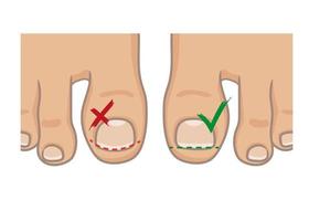 cómo cortar las uñas de los pies, el concepto correcto e incorrecto. como evitar una uña encarnada. planta del pie femenino o masculino, descalzo, vista superior. ilustración vectorial, estilo de dibujos animados dibujados a mano aislado en blanco. vector