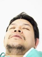 hombre asiático está recibiendo tratamiento de acupuntura foto