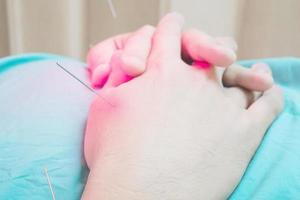 Asian man is receiving Acupuncture treatment. Closeup at his hand. photo