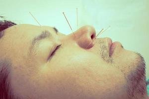 Vintage style photo of asian man is receiving Acupuncture treatment
