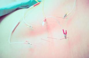 Vintage style photo of asian man is receiving acupuncture treatment. Closeup at needles at his back with electricity pulses call electroacupuncture.