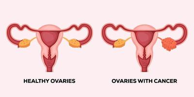 illustration healthy ovaries, and ovaries with cancer vector