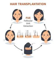 Stages of woman hair transplantation FUE Follicular Unit Extraction. Treatment of baldness, alopecia and hair loss. Vector medical infographics, a female head scalp. Strip, graft machine.