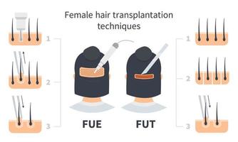 Female hair transplantation FUE and FUT comparison, stages of Follicular Unit Extraction. Treatment of baldness, alopecia and hair loss. Vector medical infographic, woman's head and nape