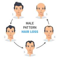 etapas de pérdida de cabello, patrón masculino de alopecia androgenética. pasos de infografía vectorial de calvicie en un estilo plano con un hombre. millas por hora vector