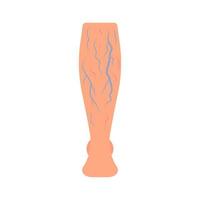 Leg with spider vascular and vein from pressure, disease varicose, thrombosis. Deep vein thrombosis DVT , abnormally of blood vascular flow. Blocked circulation in blood vessel. Vector illustration