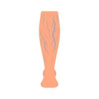 Leg with spider vascular and vein from pressure, disease varicose, thrombosis. Deep vein thrombosis DVT , abnormally of blood vascular flow. Blocked circulation in blood vessel. Vector illustration